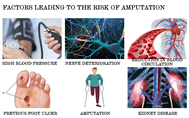 Factors leading to the risk of amputation