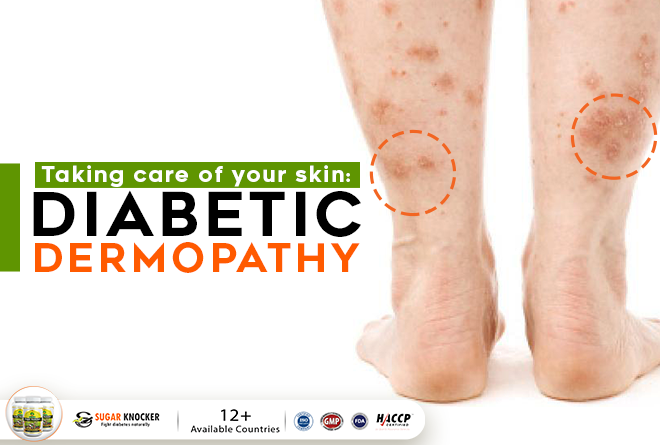 Diabetic Dermopathy, Diabetes Itching Skin Treatment and How to Save Our Skin From It