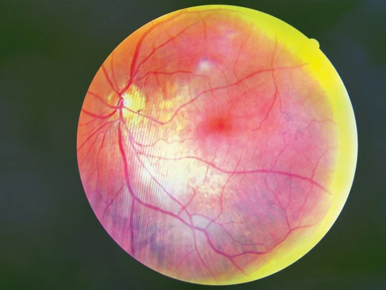 how to prevent diabetic retinopathy